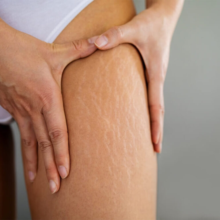 MolesWartsStretch Marks Removal