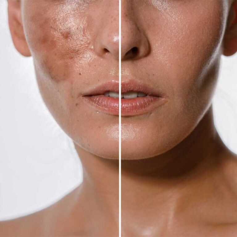 Pigmentation & Melasma Solutions