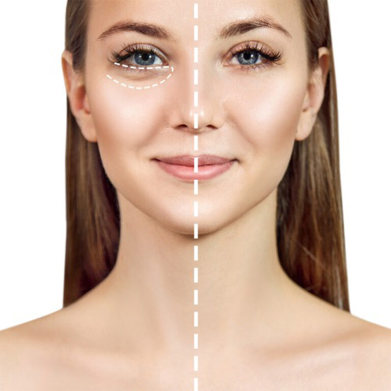 oDark Circles Reduction