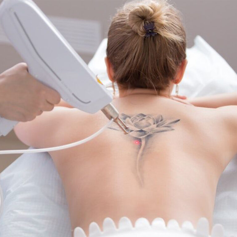 oTattoo Removal
